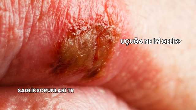 Uçuğa Ne İyi Gelir?