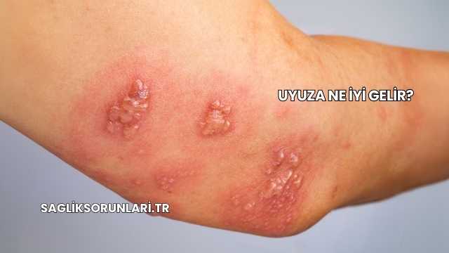 Uyuza Ne İyi Gelir?