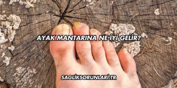 Ayak Mantarına Ne İyi Gelir?