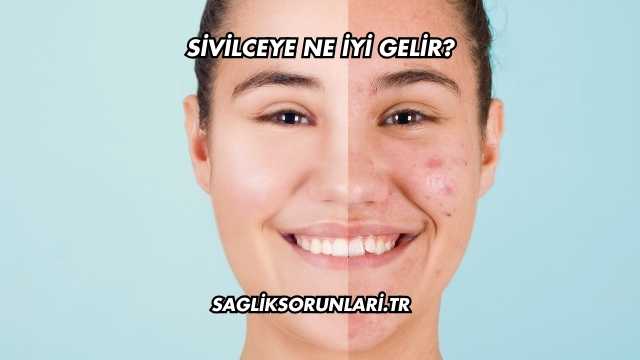 Sivilceye Ne İyi Gelir?