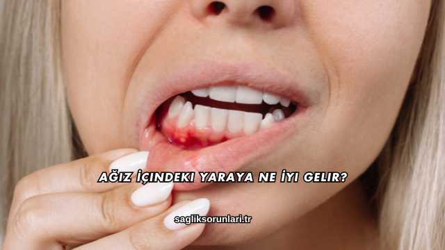 Ağız İçindeki Yaraya Ne İyi Gelir?