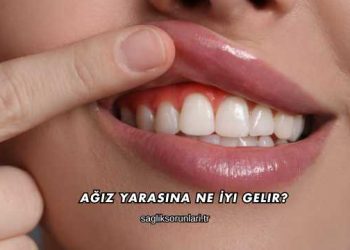 Ağız Yarasına Ne İyi Gelir?