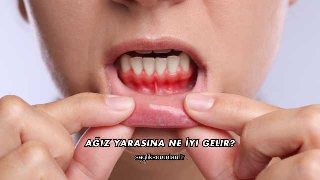 Ağız Yarasına Ne İyi Gelir?
