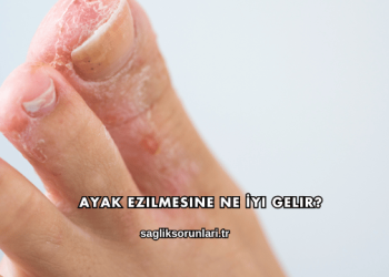 Ayak Ezilmesine Ne İyi Gelir?