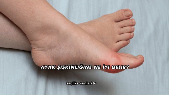 Ayak Şişkinliğine Ne İyi Gelir?