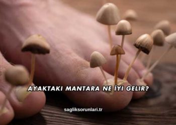 Ayaktaki Mantara Ne İyi Gelir?