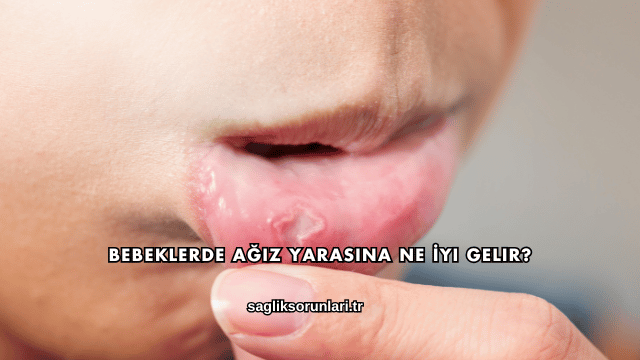 Bebeklerde Ağız Yarasına Ne İyi Gelir?