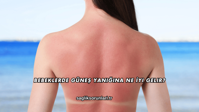 Bebeklerde Güneş Yanığına Ne İyi Gelir?