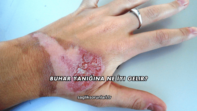 Buhar Yanığına Ne İyi Gelir?