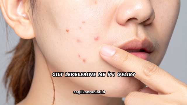 Cilt Lekelerine Ne İyi Gelir?