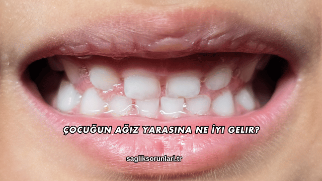 Çocuğun Ağız Yarasına Ne İyi Gelir?