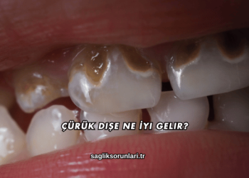 Çürük Dişe Ne İyi Gelir?