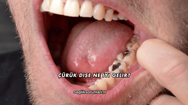Çürük Dişe Ne İyi Gelir?