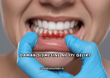 Damak Şişmesine Ne İyi Gelir?