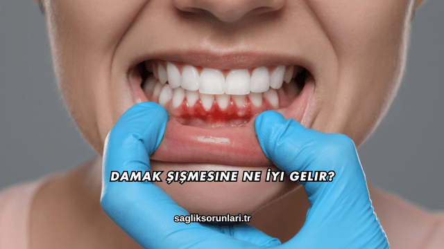 Damak Şişmesine Ne İyi Gelir?