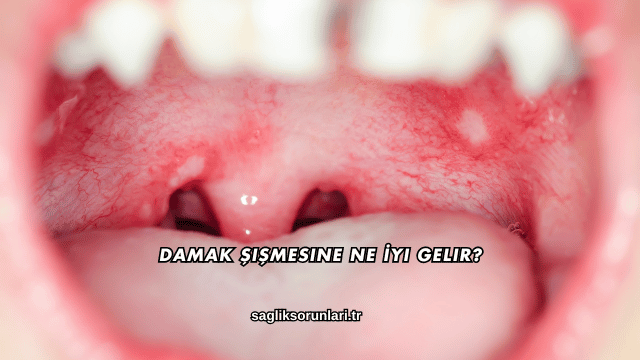 Damak Şişmesine Ne İyi Gelir?