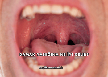 Damak Yanığına Ne İyi Gelir?