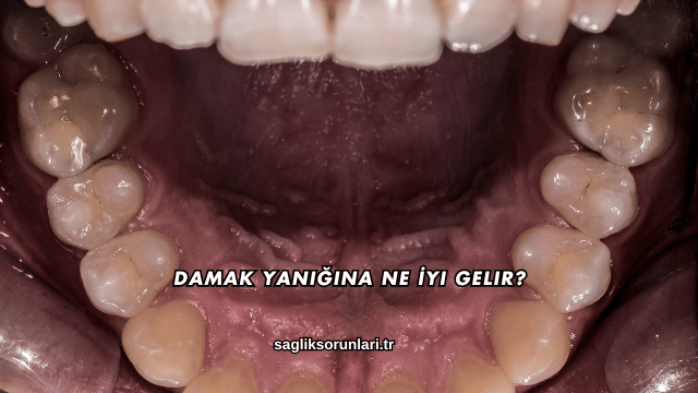 Damak Yanığına Ne İyi Gelir?