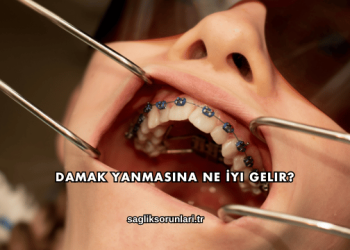 Damak Yanmasına Ne İyi Gelir?