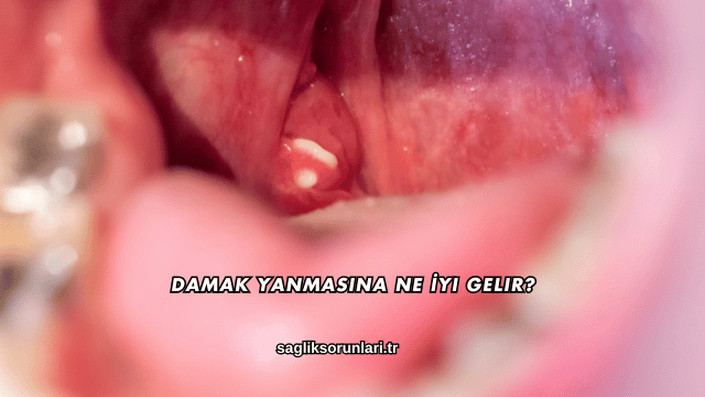 Damak Yanmasına Ne İyi Gelir?