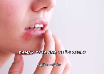Damak Yarasına Ne İyi Gelir?