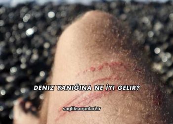 Deniz Yanığına Ne İyi Gelir?