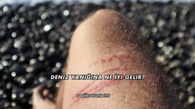 Deniz Yanığına Ne İyi Gelir?