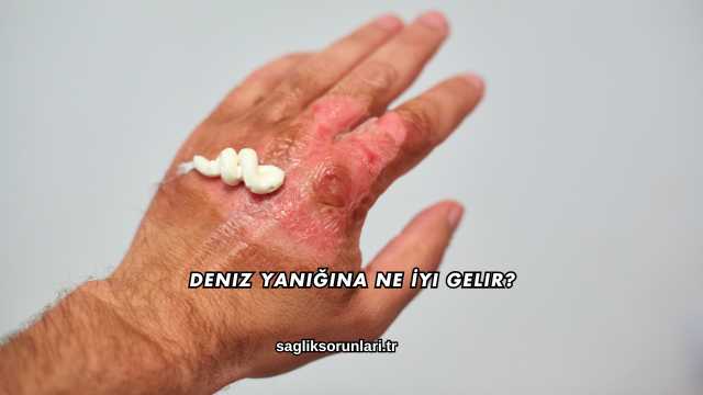 Deniz Yanığına Ne İyi Gelir?