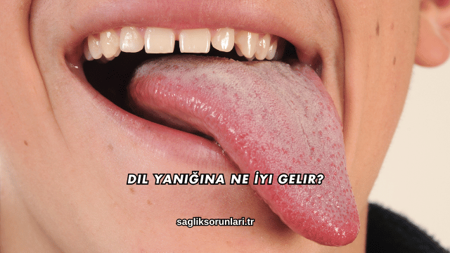 Dil Yanığına Ne İyi Gelir?