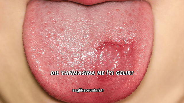 Dil Yanmasına Ne İyi Gelir?