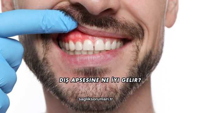 Diş Apsesine Ne İyi Gelir?