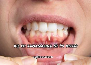 Diş Eti Kanamasına Ne İyi Gelir?