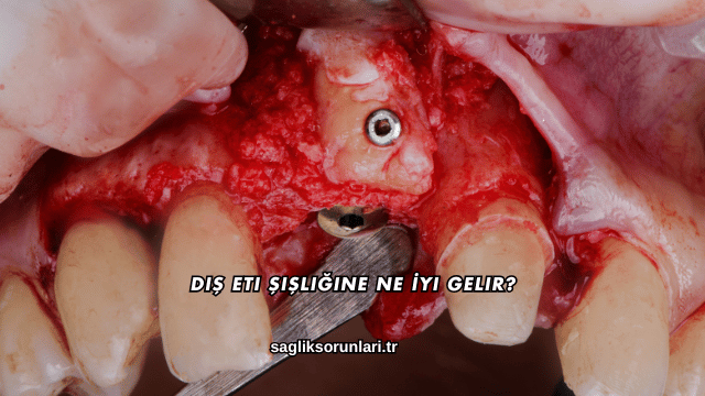 Diş Eti Şişliğine Ne İyi Gelir?