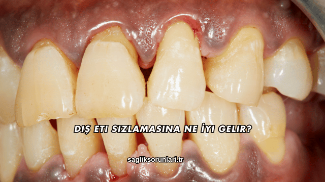 Diş Eti Sızlamasına Ne İyi Gelir?