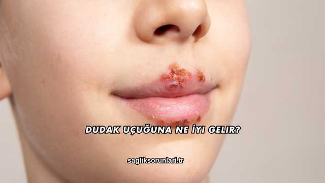 Dudak Uçuğuna Ne İyi Gelir?