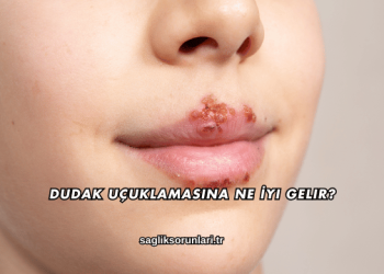 Dudak Uçuklamasına Ne İyi Gelir?
