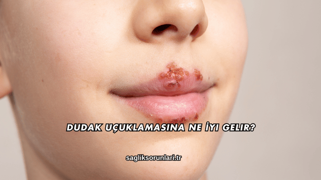 Dudak Uçuklamasına Ne İyi Gelir?