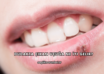 Dudakta Çıkan Uçuğa Ne İyi Gelir?