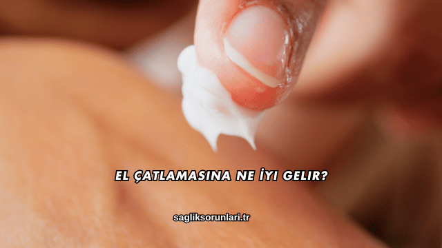 El Çatlamasına Ne İyi Gelir?