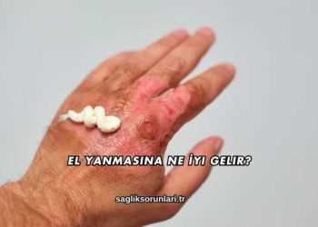 El Yanmasına Ne İyi Gelir?