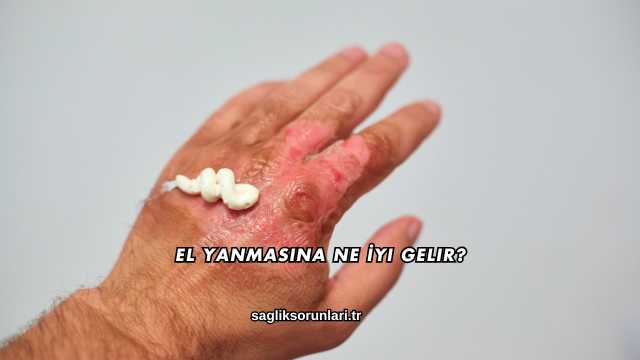 El Yanmasına Ne İyi Gelir?