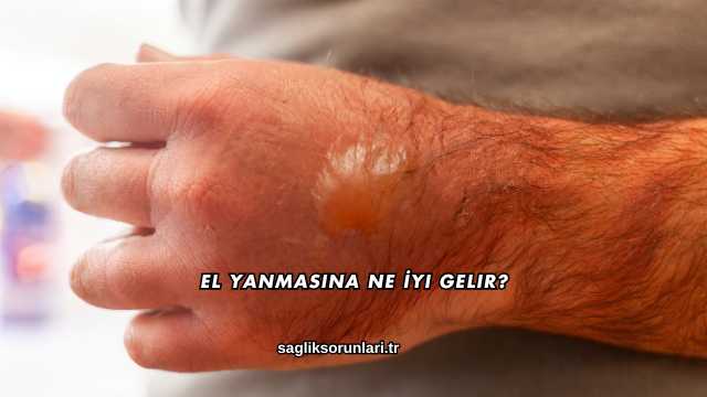 El Yanmasına Ne İyi Gelir?