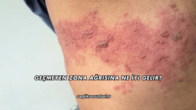 Geçmeyen Zona Ağrısına Ne İyi Gelir?