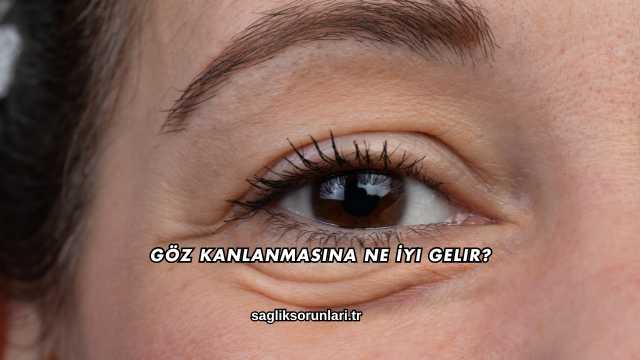Göz Kanlanmasına Ne İyi Gelir?
