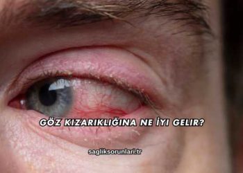 Göz Kızarıklığına Ne İyi Gelir?