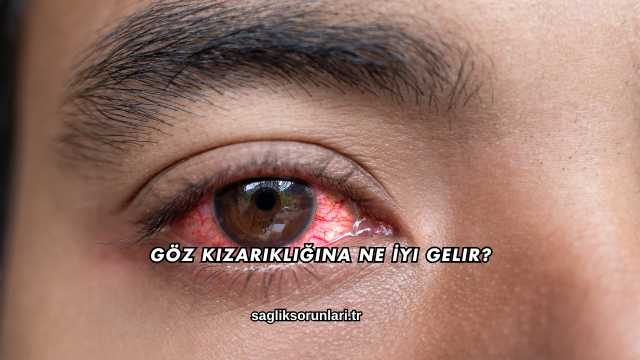 Göz Kızarıklığına Ne İyi Gelir?