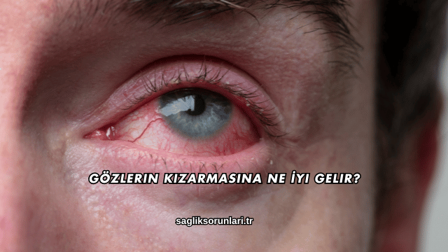 Gözlerin Kızarmasına Ne İyi Gelir?