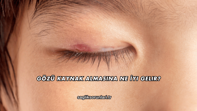 Gözü Kaynak Almasına Ne İyi Gelir?