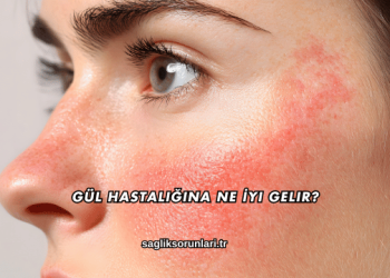 Gül Hastalığına Ne İyi Gelir?