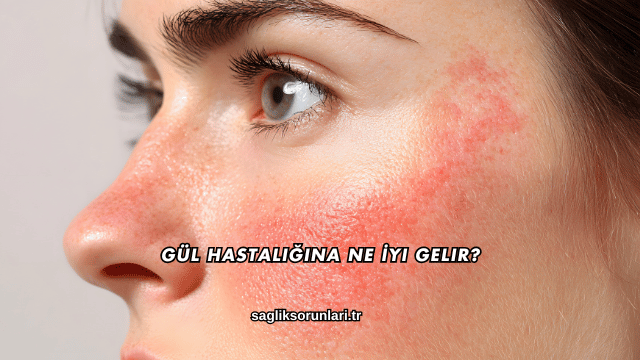 Gül Hastalığına Ne İyi Gelir?